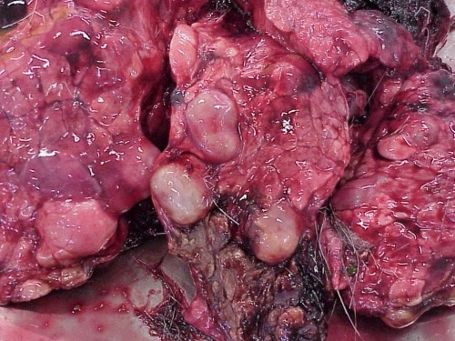 Pneumoconioze sarcoidoza, colagenoze, chistul hidatic pulmonar, scleroze pulmonare, afectiuni pleurale, tumori pleurale